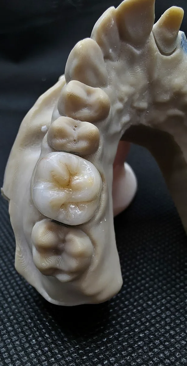 Anatomie & précision — Détail d’une restauration postérieure sur modèle
