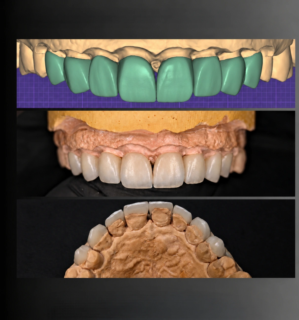 Facettes feldspathiques — De la conception à la réalisation